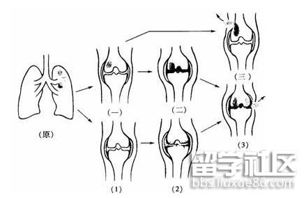 骨与关节结核概论.png